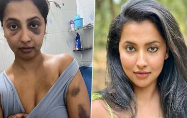 Anicka Vijayi Vikramman: முன்னாள் காதலனால் சித்ரவதையை சந்தித்த பிரபல நடிகை....முகமெல்லாம் வீங்கி, மார்பெல்லாம் காயம்.. பதற்றத்தில் திரையுலகினர்.!.