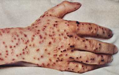 Small Pox: தமிழகத்தில் பரவும் சின்னம்மை; தடுப்பு நடவடிக்கைகள் எடுக்க மாவட்ட சுகாதாரத்துறைக்கு அதிகாரிகளுக்கு அறிவுறுத்தல்.!