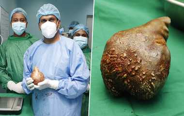 Kidney Stone Guinness Record: அம்மாடியோவ்... உலகிலேயே மிகப்பெரிய சிறுநீரக கல் அறுவை சிகிச்சை மூலம் வெளியேற்றம்; கின்னஸ் சாதனையில் பதிவு..!