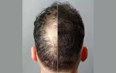 Hair Serum: முடி கொட்டுதா.. அப்போ இந்த ஹேர் சீரத்தை செய்துப் பாருங்கள்..!