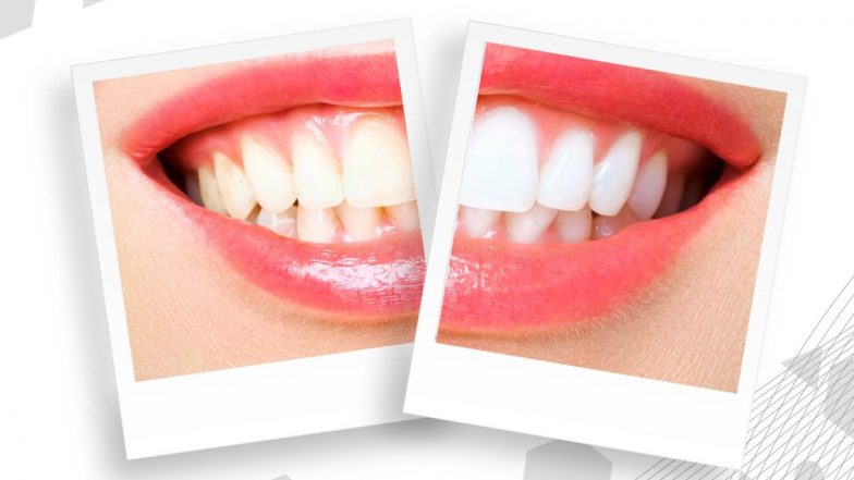 Whiten Your Teeth at Home: பளபளப்பான பற்கள் வேண்டுமா? இந்த வழிமுறைகளை பின்பற்றுங்கள்...!