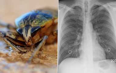 Cockroach From Man's Lungs: மனிதனின் நுரையீரலில் கரப்பான் பூச்சி.. வெற்றிகரமாக நீக்கிய மருத்துவர்கள்..!